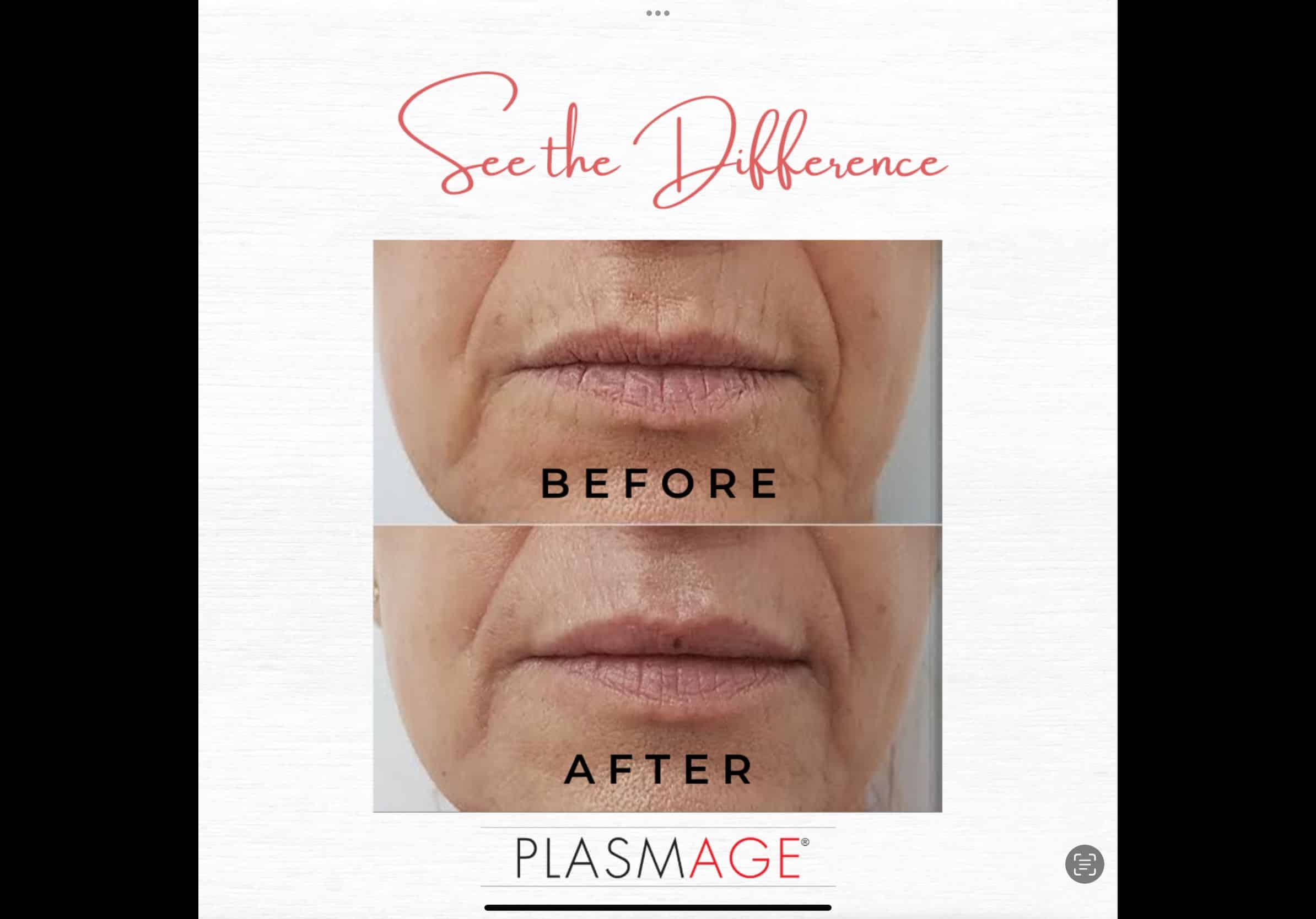 plasmage before and after