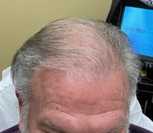Before Image: TED Hair Restoration Procedure